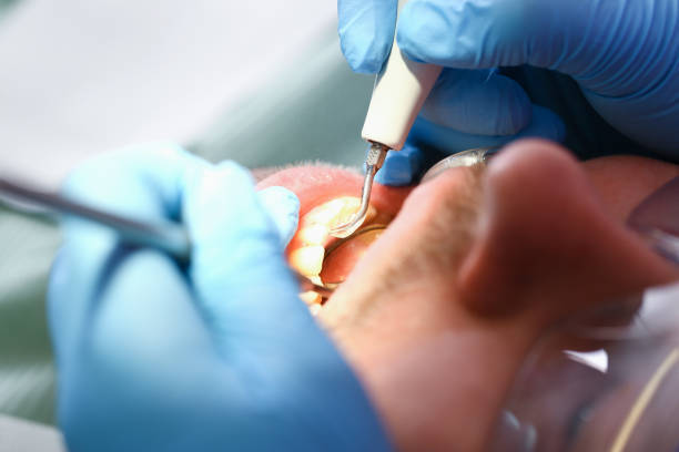 Best Emergency Dentist for Lost Fillings or Crowns in Seven Fields, PA